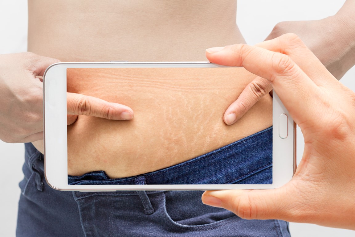 Smagliature della pelle, come prevenirle e i rimedi naturali per combatterle