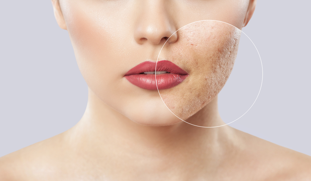 Acne, come funziona il laser per rimuovere le cicatrici