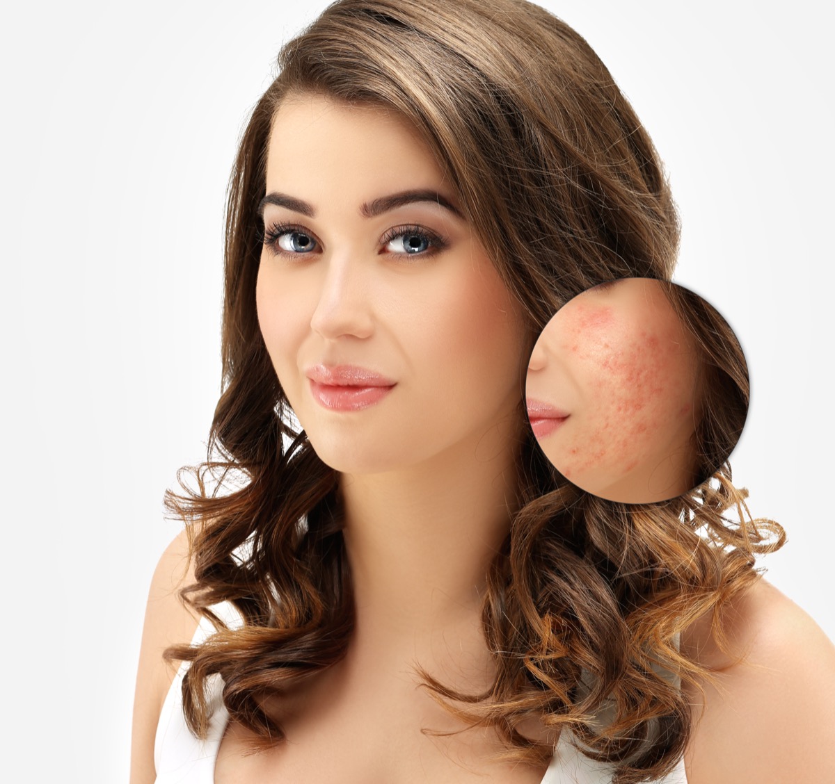 I rimedi naturali contro le cicatrici da acne sulla pelle
