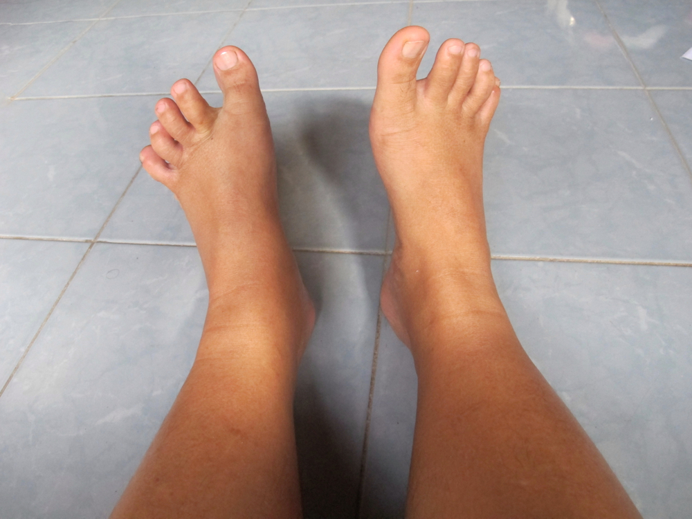 Caviglie gonfie: cause e rimedi