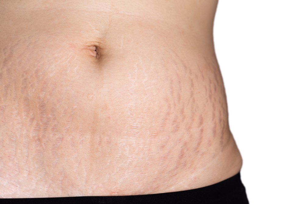 Come togliere le smagliature rosse