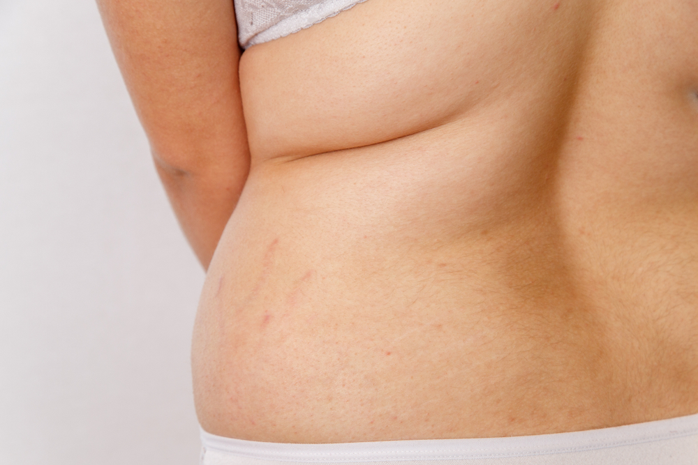 Come tonificare la pelle dopo aver perso peso