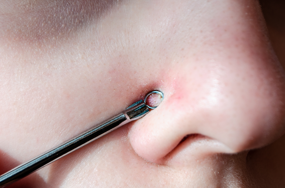 Come schiacciare i punti neri