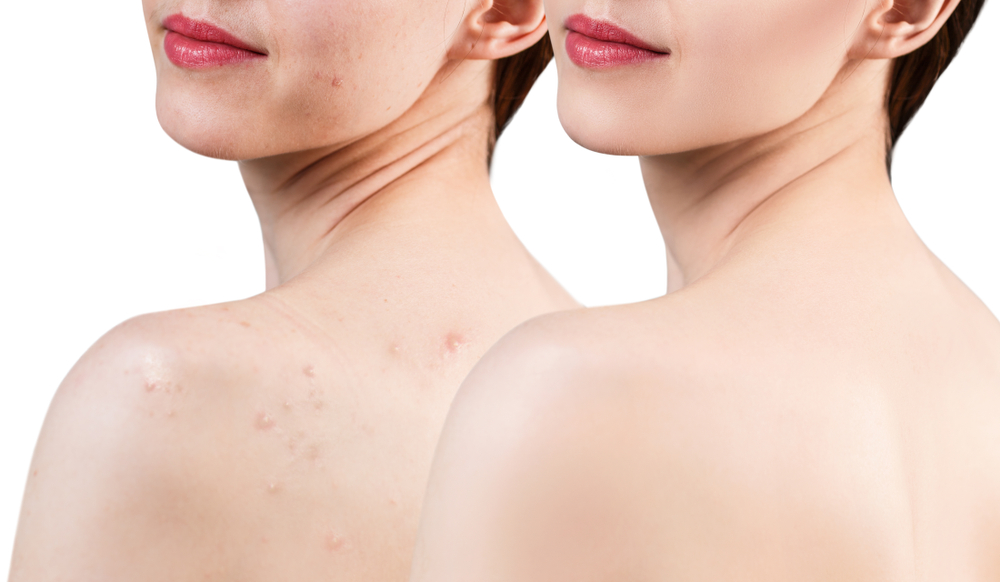 5 modi per prevenire l’acne sul corpo