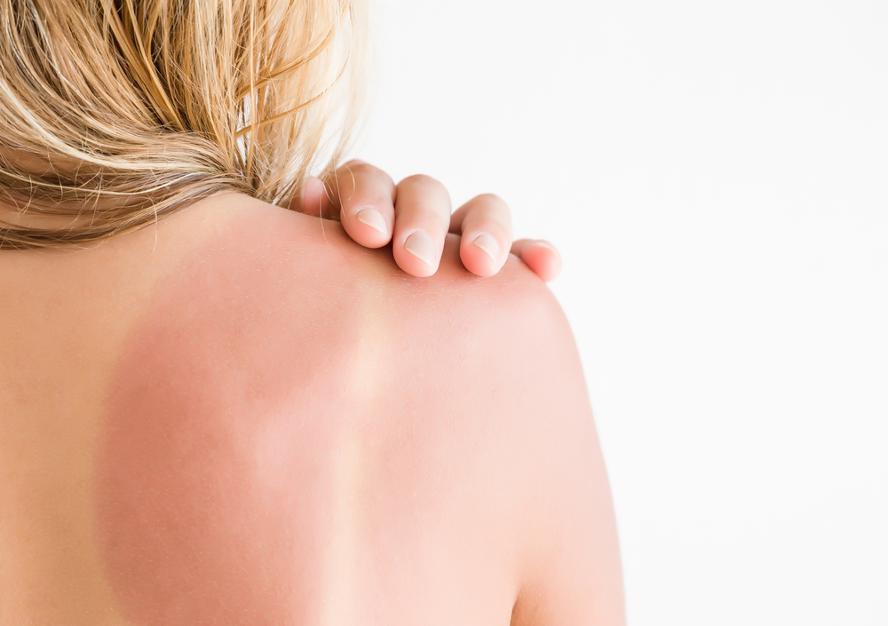 Come si cura una scottatura solare