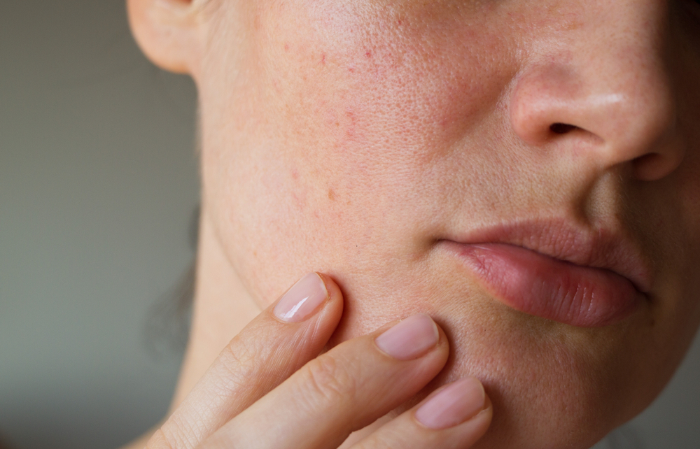 8 motivi per cui ti è comparsa l’acne in età adulta