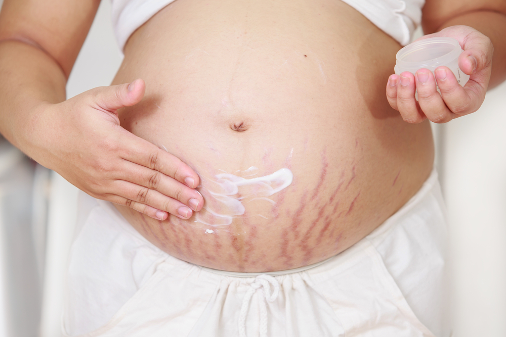 Come prevenire le smagliature in gravidanza