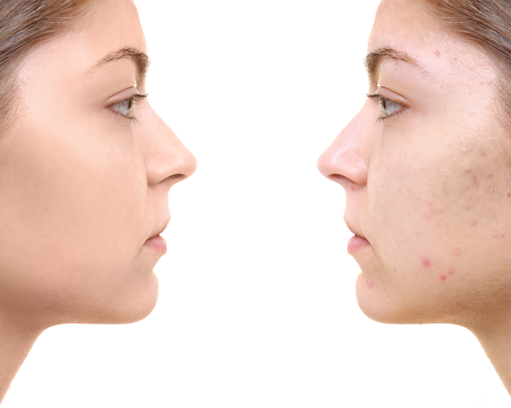 3 consigli per eliminare i segni dell'acne