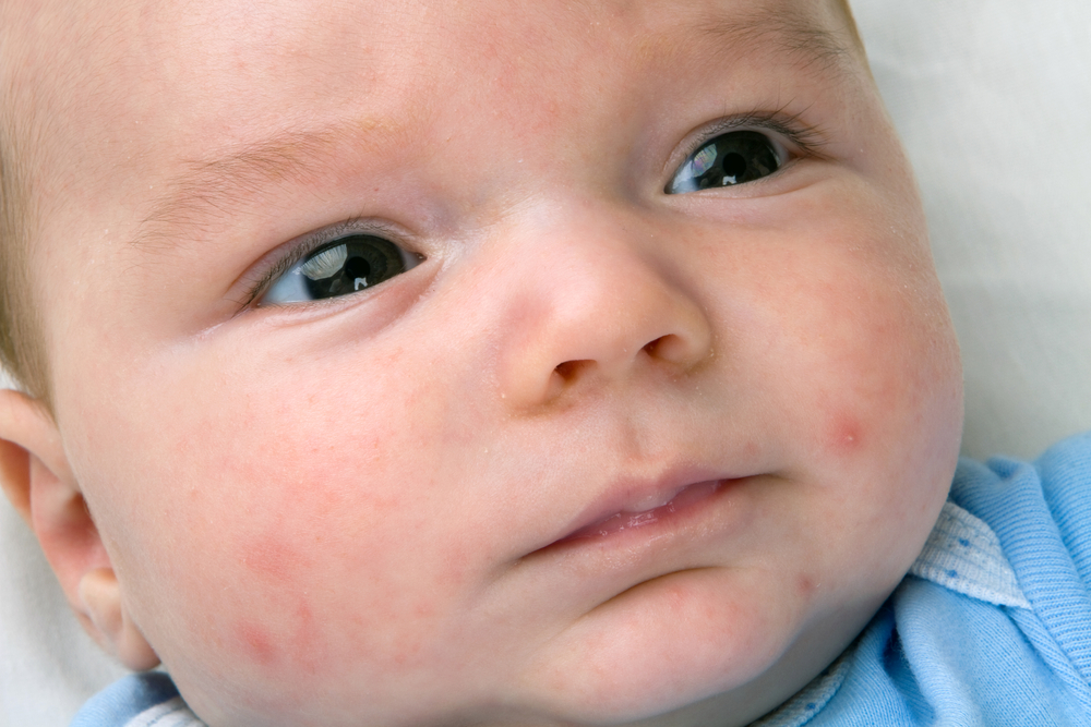 Acne nel bambino: che cosa fare