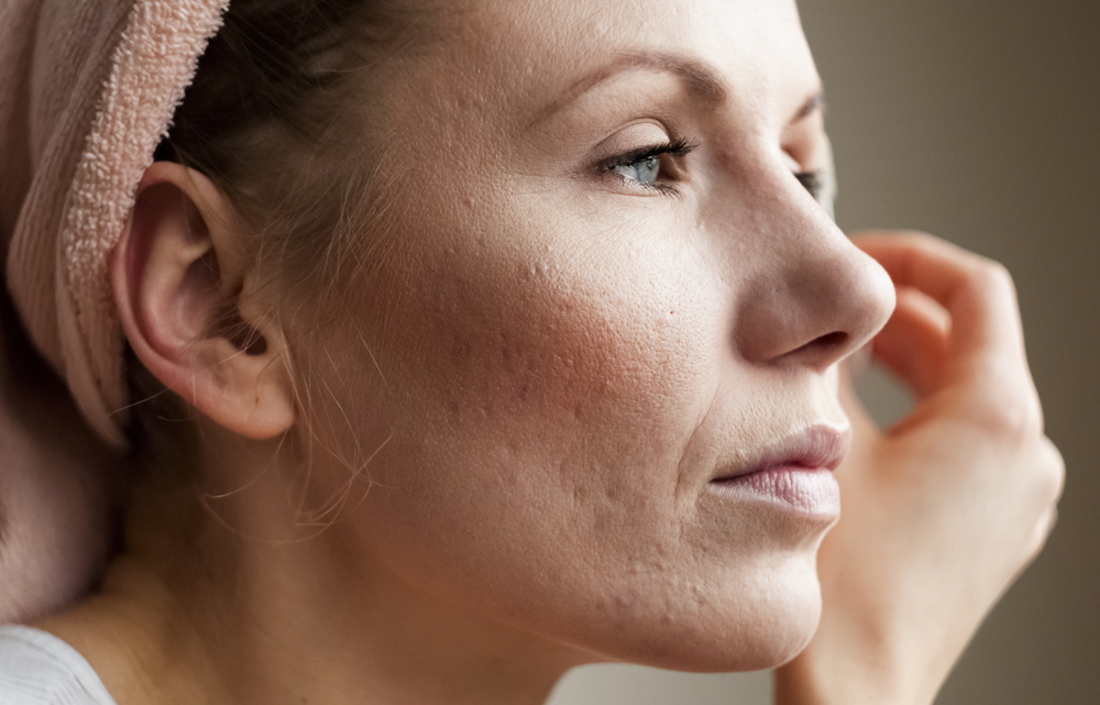 Acne dopo la gravidanza: che cos’è e quali sono le cause?