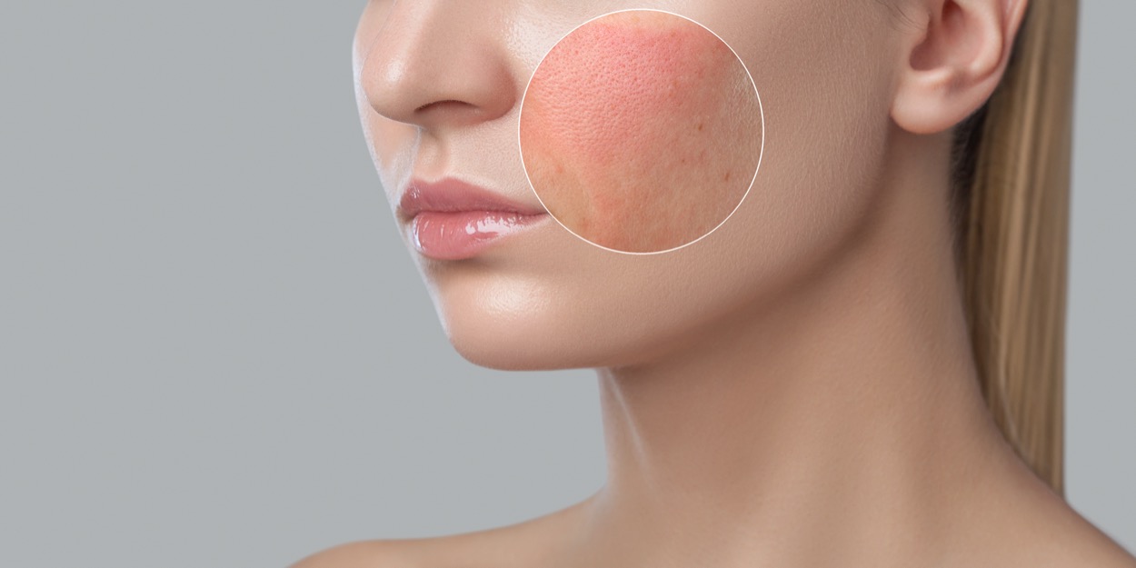 Make-up per dermatite atopica: come truccarsi