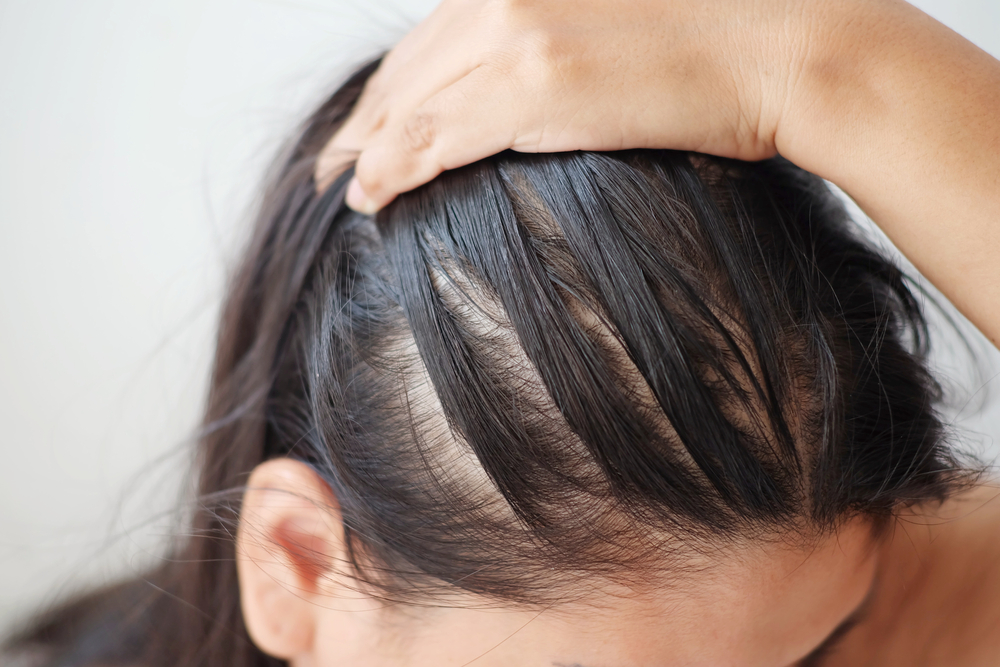 Perdita dei capelli frontale: che cos’è e da che cosa dipende?