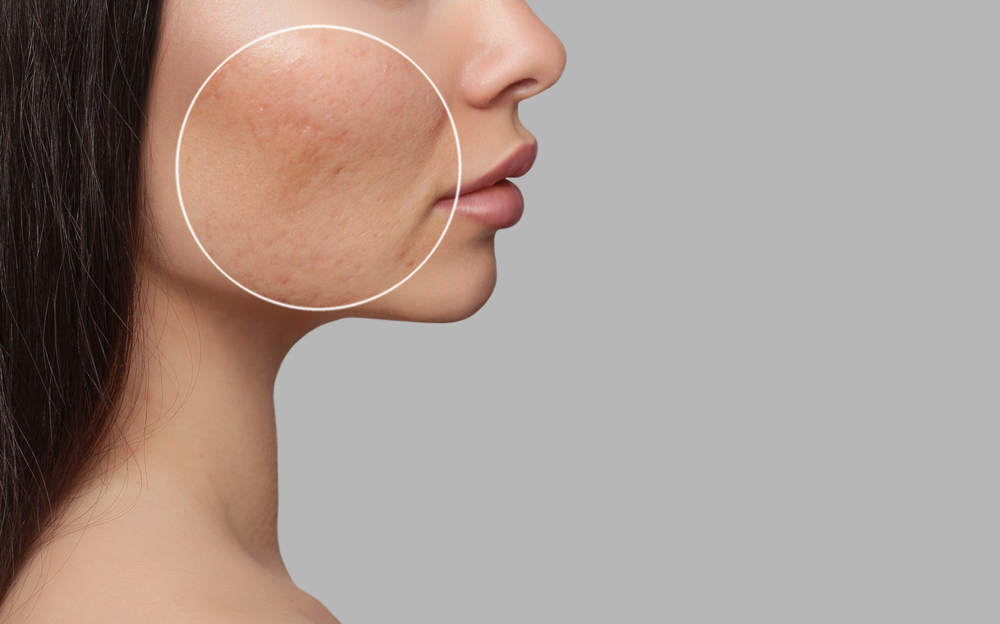 Come coprire una cicatrice con il trucco