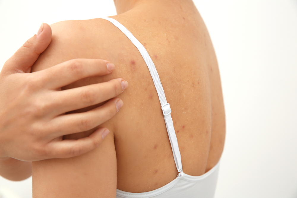 Acne sulla schiena: consigli per curarla e prevenirla