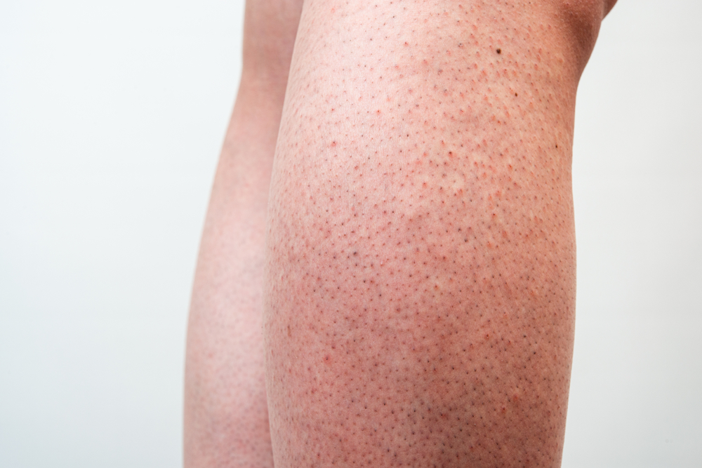 Cosa sono le gambe di fragola e come si curano