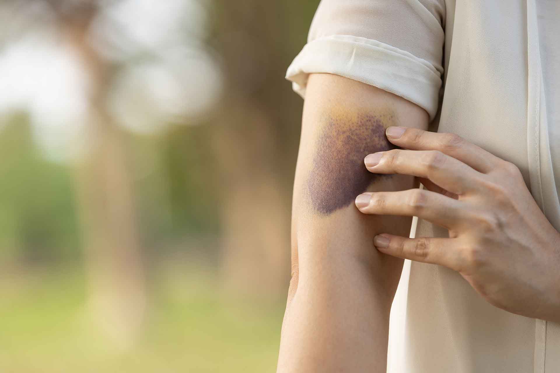 Ematoma, i rimedi della nonna per farlo guarire velocemente