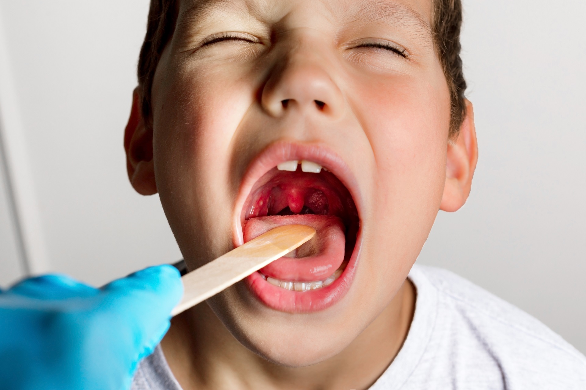 10 cose da sapere sulla tonsillite