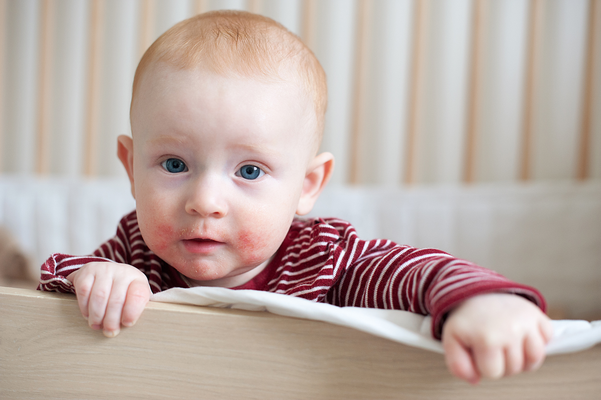 Dermatite atopica nei bambini: cause e rimedi
