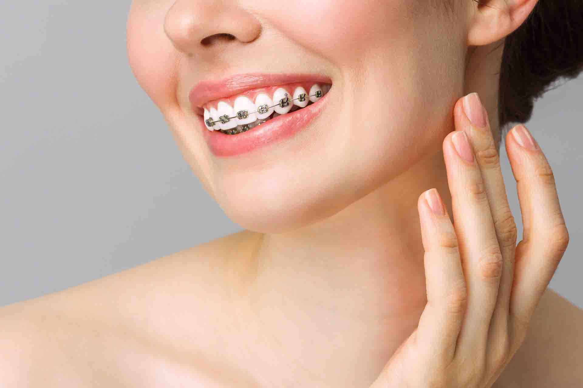 Come prendersi cura dell'apparecchio dei denti