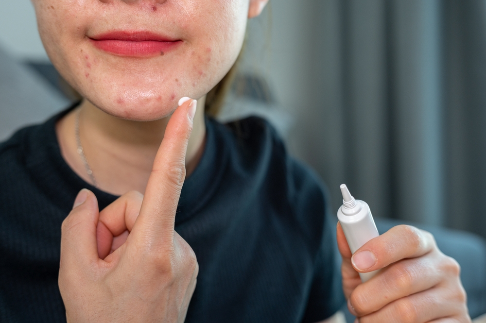 Cerotti liquidi per i brufoli: che cosa sono e come funzionano?