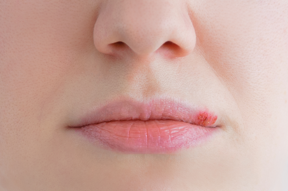 Tatuaggio permanente sulle labbra: si può fare con l'herpes?