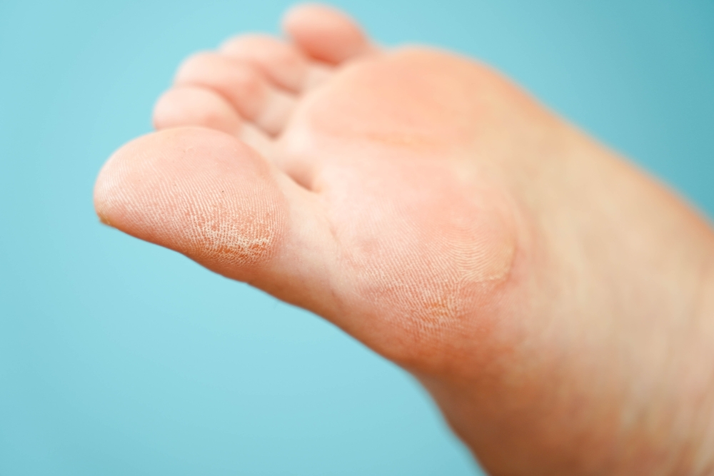Piedi screpolati: quali sono le cause principali?