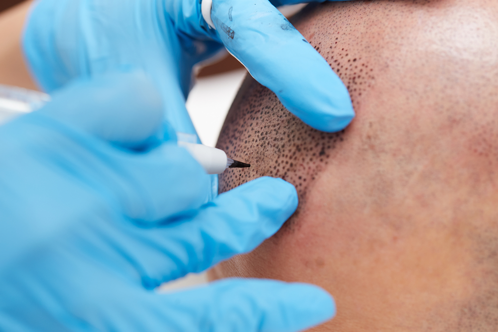 Che cos’è il tatuaggio dei capelli