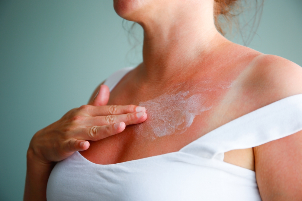 Come curare velocemente le scottature solari e non rovinarsi le vacanze