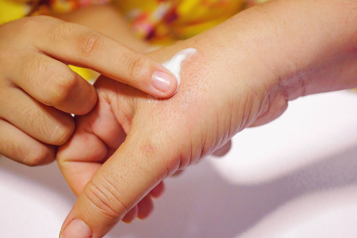 Scottature: i migliori rimedi naturali