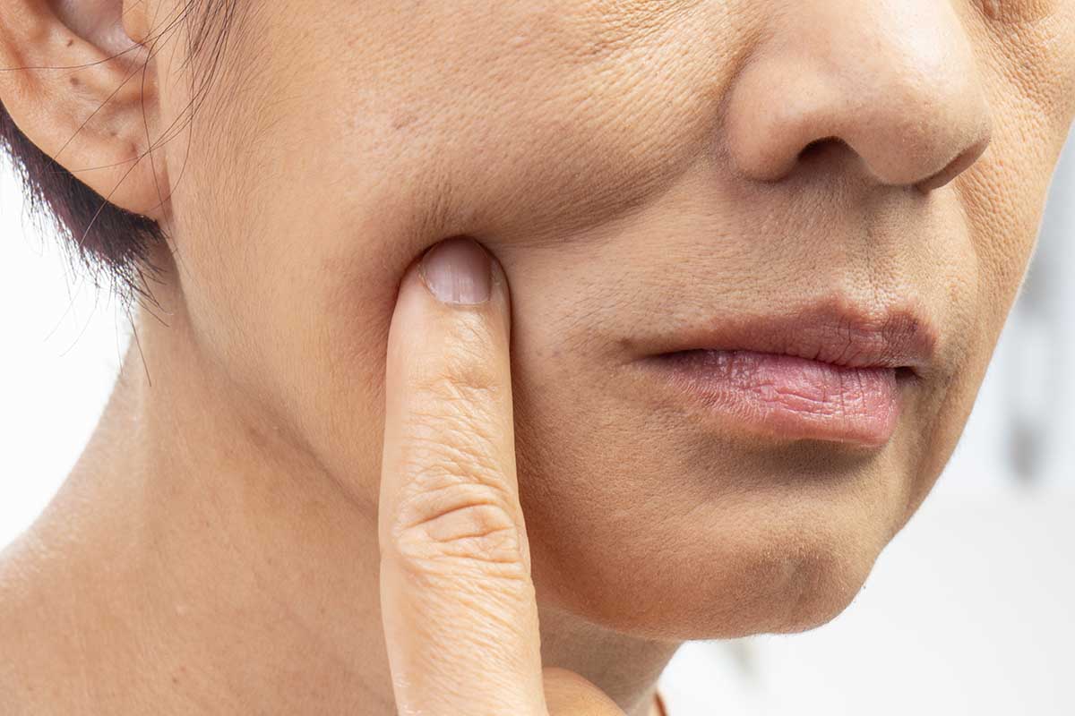 Rughe intorno alla bocca: come rimediare
