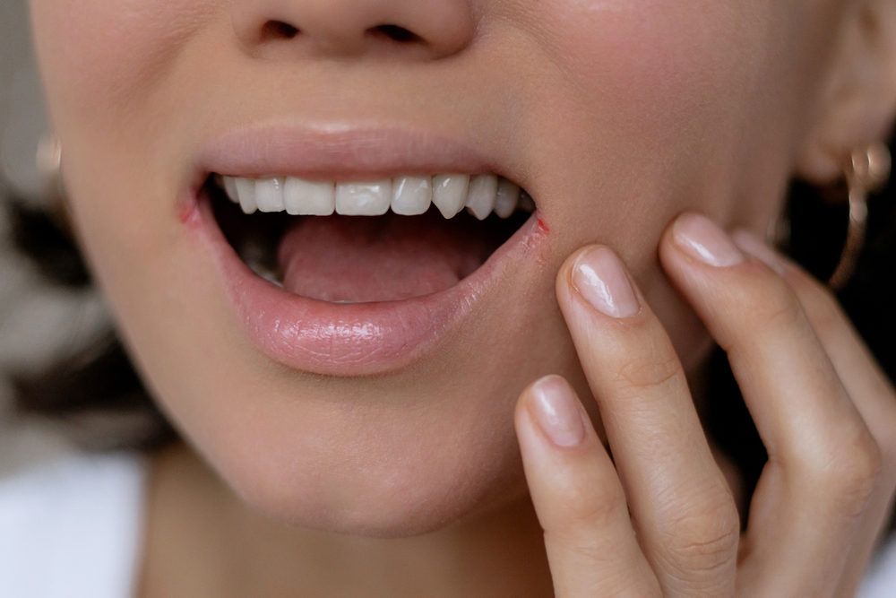 Cheilite angolare: che cos’è e come si cura